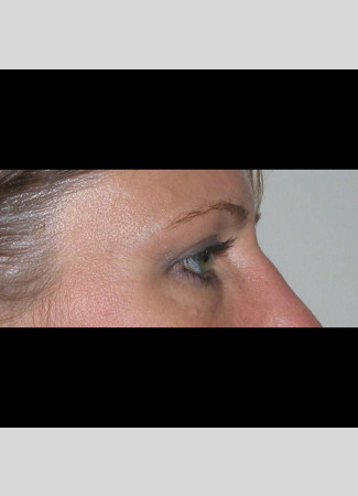 After This 50 year old female wanted a more “open” look to her eyes.  She had an upper blepharoplasty to remove excess skin and fat from her upper eyelids.  Her “after” photos were taken about 1 year after surgery.