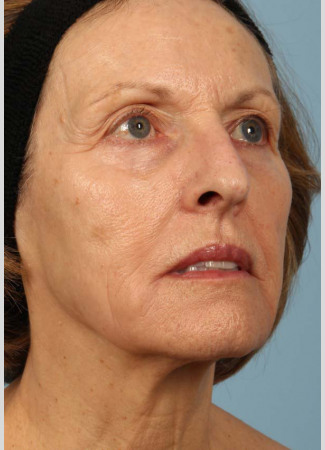 After This 68 year old Atlanta woman had a consultation with Dr. Kavali for facial rejuvenation.  Together, they decided that a variety of fillers would be best.  She had 4 syringes of Voluma in her cheeks, a syringe of Restylane Silk in her lips and around her mouth for the fine lines, and a syringe of Juvederm Ultra Plus in the nasolabial folds (smile lines). She is shown about 2 weeks after her treatment was done.