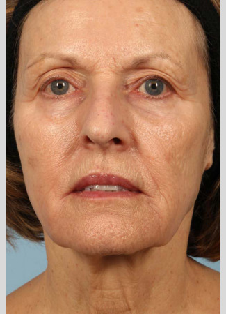 After This 68 year old Atlanta woman had a consultation with Dr. Kavali for facial rejuvenation.  Together, they decided that a variety of fillers would be best.  She had 4 syringes of Voluma in her cheeks, a syringe of Restylane Silk in her lips and around her mouth for the fine lines, and a syringe of Juvederm Ultra Plus in the nasolabial folds (smile lines). She is shown about 2 weeks after her treatment was done.