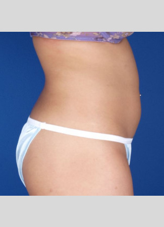 Before This 27 year old female had CoolSculpting to contour her abdomen, waist, and lower back.  She had a total of 6 treatment hours.  Her “after” photos were taken about 60 days after her last treatment.