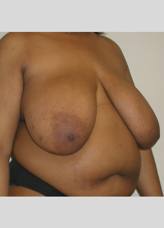 Before This 31 year old female wanted smaller, lifted breasts, as well as relief from back, neck, and shoulder pain. Dr. Kavali performed a SPAIR Short Scar Breast Reduction, removing about 900 grams per breast. Her “after” photos were taken about 6 months after surgery.