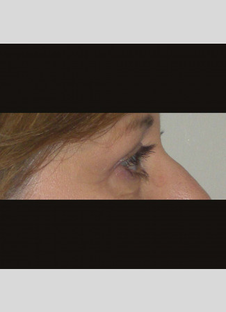After This 50 year old female had upper blepharoplasty to remove extra fat and skin in the upper eyelids.  Her surgery was done in the office under local anesthesia.