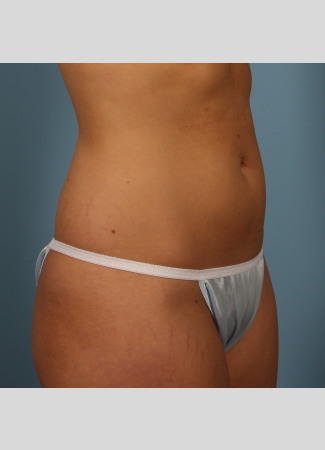 After This 22 year old underwent CoolSculpting for her abdomen and waist.  Her photos were taken about 3 months after having 6 treatment cycles.