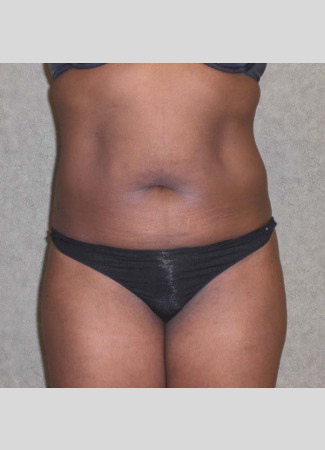 Before This 46 year old female had 2 hours of CoolSculpting to contour her upper and lower central abdomen.