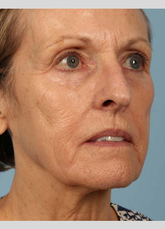 Before This 68 year old Atlanta woman had a consultation with Dr. Kavali for facial rejuvenation.  Together, they decided that a variety of fillers would be best.  She had 4 syringes of Voluma in her cheeks, a syringe of Restylane Silk in her lips and around her mouth for the fine lines, and a syringe of Juvederm Ultra Plus in the nasolabial folds (smile lines). She is shown about 2 weeks after her treatment was done.