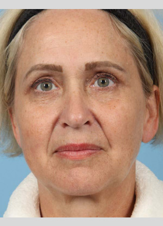 After This 56 year-old Atlanta woman had a consultation with Dr. Kavali and decided to have Voluma for facial volume replacement.  She is shown after having 4 syringes of Voluma.