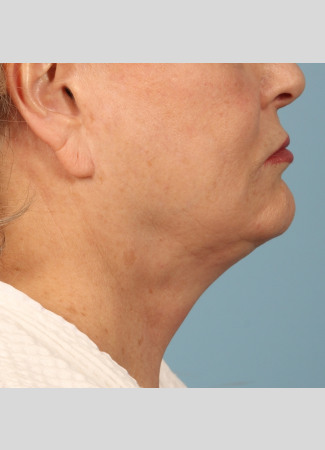 Before Results after 2 Kybella treatments