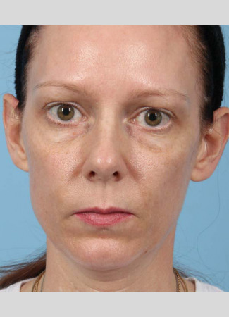 Before This 43 year old Atlanta woman chose fillers for facial rejuvenation.  Dr. Kavali used Voluma in the cheeks and Restylane in the hollows under the eyes.  Her “after” photos were taken immediately following the treatment.