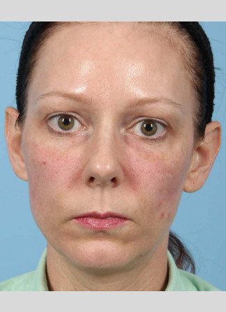 After This 43 year old Atlanta woman chose fillers for facial rejuvenation.  Dr. Kavali used Voluma in the cheeks and Restylane in the hollows under the eyes.  Her “after” photos were taken immediately following the treatment.
