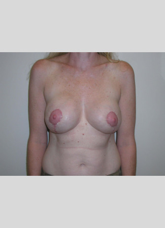 After This woman in her 40s desired a breast lift, but didn’t want to be any larger.  She had a SPAIR short scar breast lift with no implants.  Her “after” photos were taken about 6 weeks after surgery, so her scars will continue to fade over time.