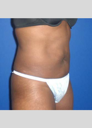 After This 46 year old female had 2 hours of CoolSculpting to contour her upper and lower central abdomen.