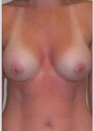 After This 37 year old female chose 350 cc silicone gel implants for her breast augmentation.  Her implants are beneath the muscle, and an inframammary crease incision was used.  Her “after” photos were taken about 1 year after surgery.