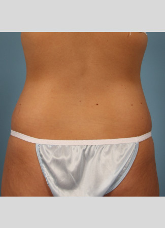 After This 22 year old underwent CoolSculpting for her abdomen and waist.  Her photos were taken about 3 months after having 6 treatment cycles.