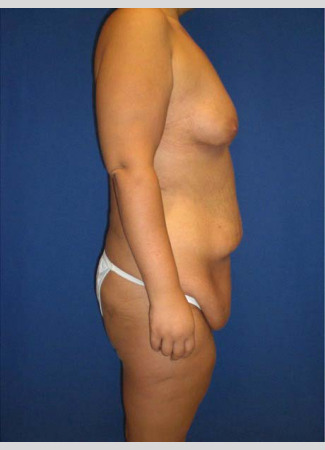 Before This 20 year old female lost 120 pounds after gastric bypass surgery.  Dr. Kavali performed a Lower Body Lift, Upper Body Lift, Vertical Thigh Lift, and Breast Augmentation and Lift using 400 cc gel implants.