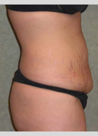 Drainless Tummy Tuck Vs Tummy Tuck With Drains