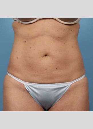 After This 37 year old female had 4 cycles of CoolSculpting on her abdomen.  Her “after” photos were taken only 30 days after her treatment.