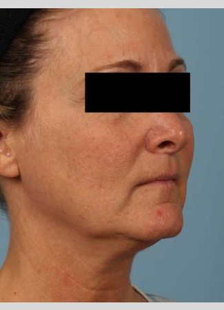 Before This 52 year-old Atlanta woman wanted a more youthful contour to her face, as well as smoother lines and brighter skin.  She has eMatrix sublative skin treatments, and she had 3 syringes of Voluma in her cheeks, and one syringe of Juvederm Ultra Plus in her nasolabial folds (smile lines).