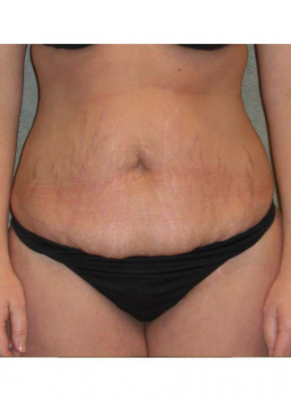 Before This mom had an abdominoplasty (tummy tuck) to remove loose skin an