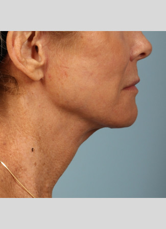 After A smoother, tighter jawline, neck and lower face after a facelift and necklift.  The after photo is about 1 year after surgery.