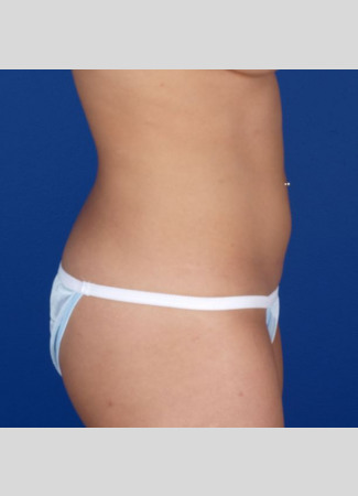 After This 27 year old female had CoolSculpting to contour her abdomen, waist, and lower back.  She had a total of 6 treatment hours.  Her “after” photos were taken about 60 days after her last treatment.