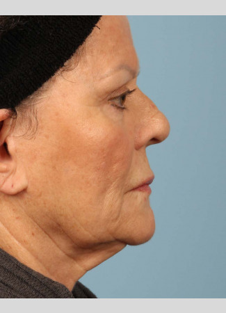 Before This 71 year-old female didn’t want any surgery, but wanted a fresher look.  She had 3 syringes of Voluma, as well as Botox for her “11s”, forehead, and crows’ feet.  She is shown about 3 months after her treatment was done.