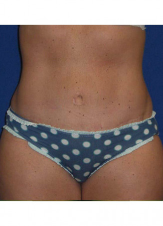 After This Atlanta mom had an abdominoplasty (tummy tuck) to remove loose skin and tighten her tummy muscles. She also had liposuction of her waist at the same time.  She is shown about 1 year after surgery.