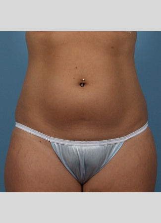 Before This 22 year old underwent CoolSculpting for her abdomen and waist.  Her photos were taken about 3 months after having 6 treatment cycles.