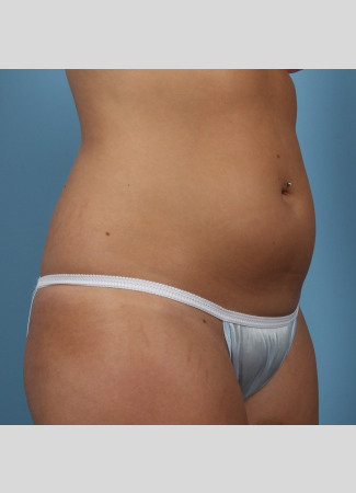 Before This 22 year old underwent CoolSculpting for her abdomen and waist.  Her photos were taken about 3 months after having 6 treatment cycles.