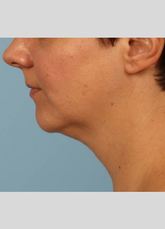 Before Results after two Kybella treatments