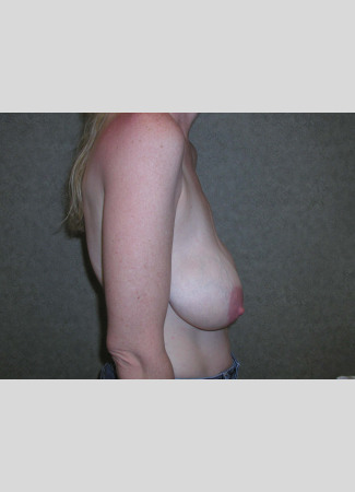 Before This woman in her 40s desired a breast lift, but didn’t want to be any larger.  She had a SPAIR short scar breast lift with no implants.  Her “after” photos were taken about 6 weeks after surgery, so her scars will continue to fade over time.