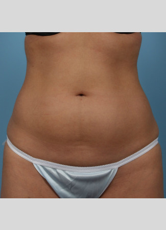 Before This 23 year old Atlanta female chose CoolSculpting to contour her abdomen.  She first had 3 treatment cycles on her lower abdomen, then came back for another 2 treatment cycles on her upper abdomen. Her final photos were taken about 2 months after her last treatment.