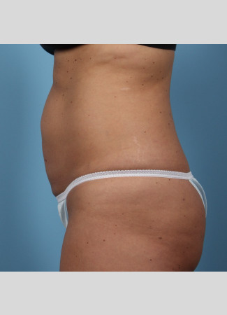 Before This 37 year old female had 4 cycles of CoolSculpting on her abdomen.  Her “after” photos were taken only 30 days after her treatment.