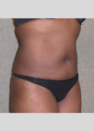 Before This 46 year old female had 2 hours of CoolSculpting to contour her upper and lower central abdomen.