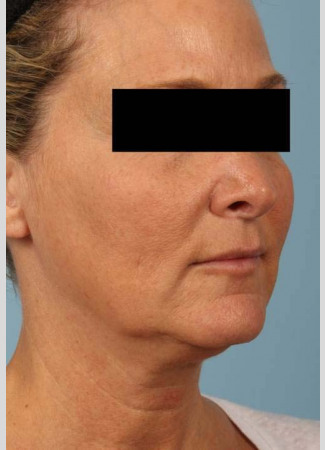 After This 52 year-old Atlanta woman wanted a more youthful contour to her face, as well as smoother lines and brighter skin.  She has eMatrix sublative skin treatments, and she had 3 syringes of Voluma in her cheeks, and one syringe of Juvederm Ultra Plus in her nasolabial folds (smile lines).
