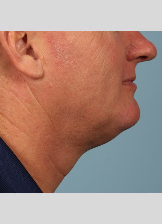 After Results after 2 Kybella Treatments