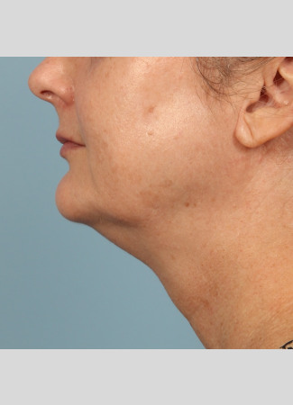 After Results after 3 Kybella Treatments