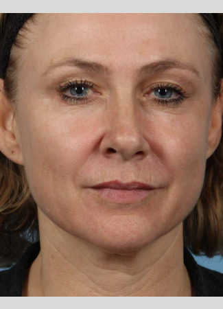 Before This 50 year-old Atlanta woman chose Voluma to restore the youthful curves in her cheeks.  Her “after” photos are taken about 1 week after the treatment was done.  The goal is to give a subtle “lift” to the cheeks, which also improves the under-eye area.