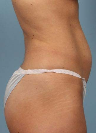 Before This Atlanta woman chose CoolSculpting to contour her abdomen. She is shown 2 months after her treatment was completed.