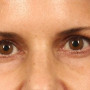 After This Atlanta woman had an upper blepharoplasty and a browlift to rejuvenate her eye appearance. thumbnail