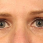 After Upper eyelid blepharoplasty gave this woman a brighter look. thumbnail