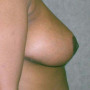After This 35 year old female desired relief from back pain and shoulder pain due to her heavy breasts.  Dr. Kavali performed a SPAIR short scar breast reduction technique and removed about 700 grams from each breast.  Her “after” photos were taken about 6 months after surgery. thumbnail