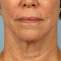 After Ulthera gave this woman a tighter jawline and slimmer neck contour.  Note how it also tightened her neck bands. thumbnail