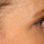 After Note the skin that is no longer sitting on the eyelash line.  After upper blepharoplasty surgery with Dr. Kavali, there is normal space now between the lashes and the skin. thumbnail