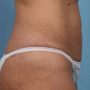 After This 37 year old female had 4 cycles of CoolSculpting on her abdomen.  Her “after” photos were taken only 30 days after her treatment. thumbnail