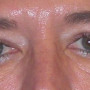 After Upper eyelid blepharoplasty removed the extra skin and fat from the eyelids and made the eyes appear more open. thumbnail