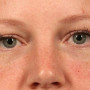After This woman wanted to correct the hollows under her eyes. We used one syringe of Juvederm Vollure and one syringe of Juvederm Ultra to get this beautiful result. The 