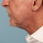 After A more defined jawline and lower face and neck in a male who chose Dr. Kavali for his facelift and necklift. thumbnail