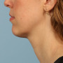 After Results after a single treatment with Kybella thumbnail