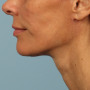 After A beautiful necklift and facelift with Dr. Kavali to tighten and define the jawline, neck, and lower face. thumbnail