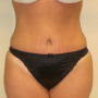 After This mom had an abdominoplasty (tummy tuck) to remove loose skin an thumbnail